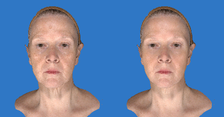 Vectra 3D Imaging | Spring Ridge Plastic Surgery Vectra 3D Imaging | Spring Ridge Plastic Surgery