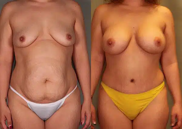 Mommy makeover before and after.