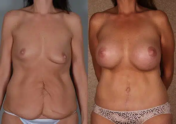 Mommy makeover before and after.