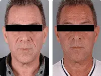 sculptra