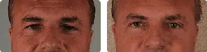 eyelid_BA