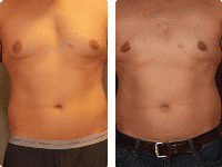 gynecomastia_BA