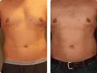gynecomastia_BA