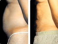 liposuction