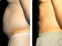 liposuction