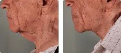 necklift_BA