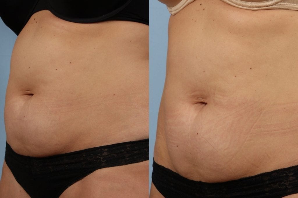 SculpSure® Before and After Photos
