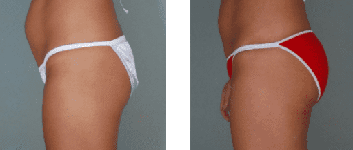 Brazilian Butt Lift Before and After Photos