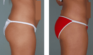 Brazilian Butt Lift Recovery Before and After Photos