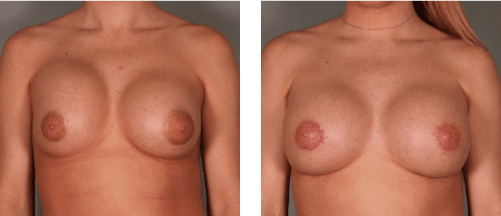 Breast Revision Surgery Before and After Photos