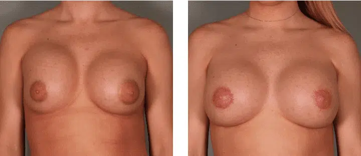 Breast Revision Surgery Before and After Photos