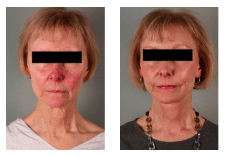 Facelift Before and After Photos