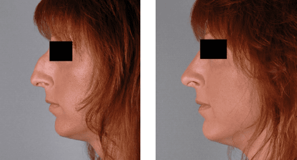 Rhinoplasty Before and After Pictures