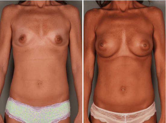 Breast Revision Before and After Photo