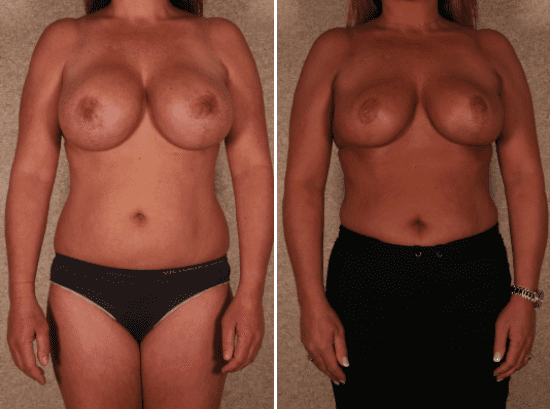 Breast Revision Before and After Photos