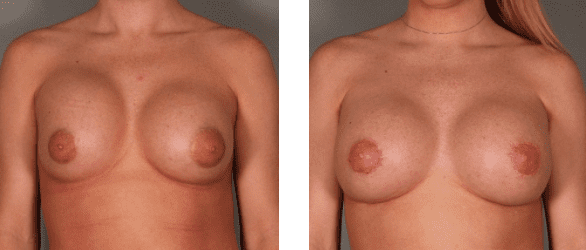 Breast Revision Before and After Photo