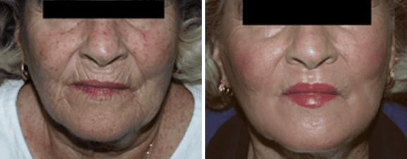 Laser Skin Resurfacing Before and After Photo