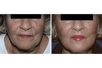 Laser Skin Resurfacing Before and After Photo