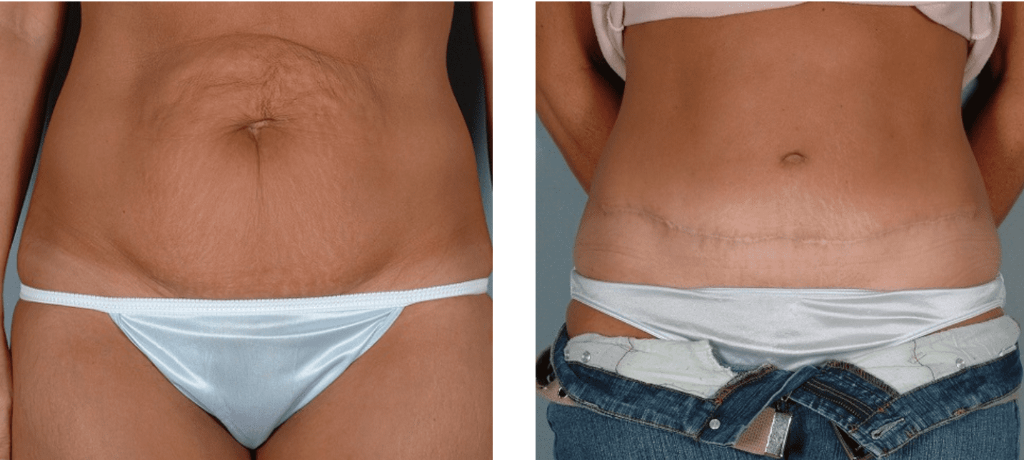 Tummy Tuck Before and After Photos