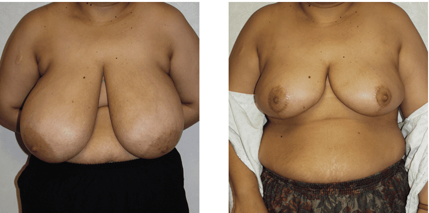 Breast Reduction Before and After Photos