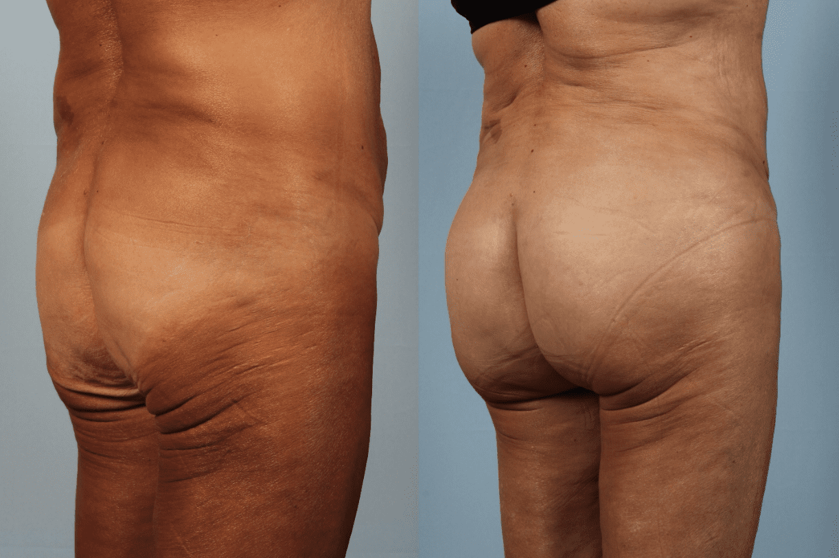 Brazilian Butt Lift Before and After Photo