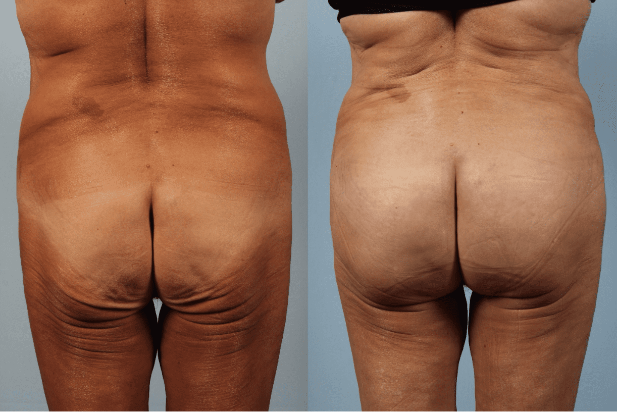 Brazilian Butt Lift Before and After Photo