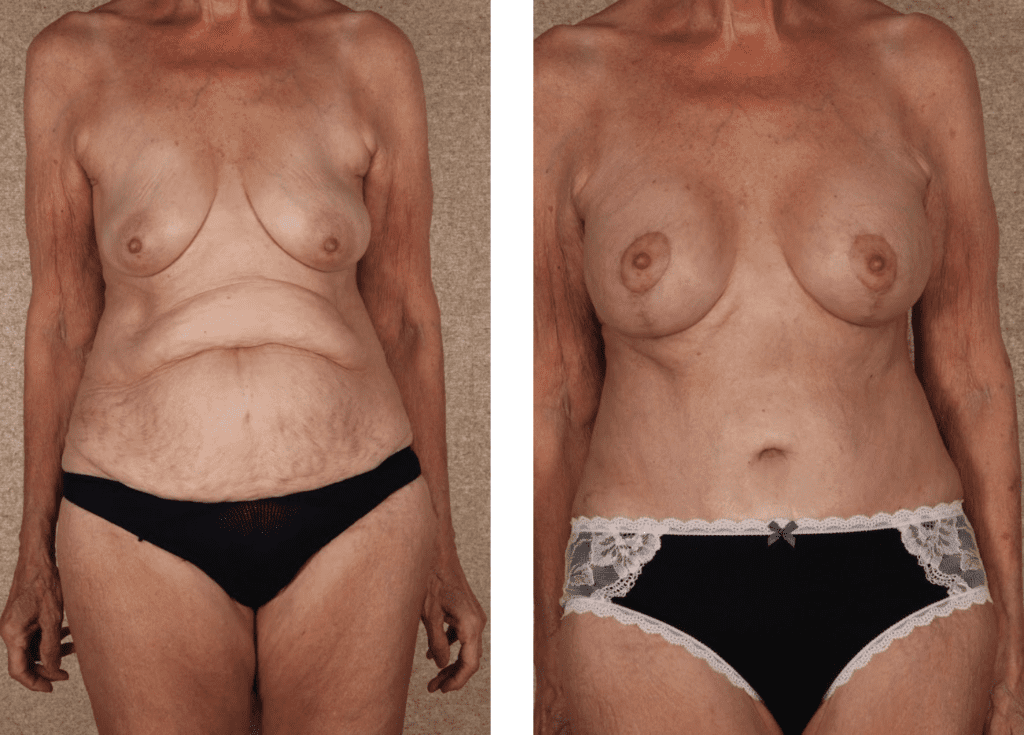 Breast Augmentation with Lift Before and After Photos