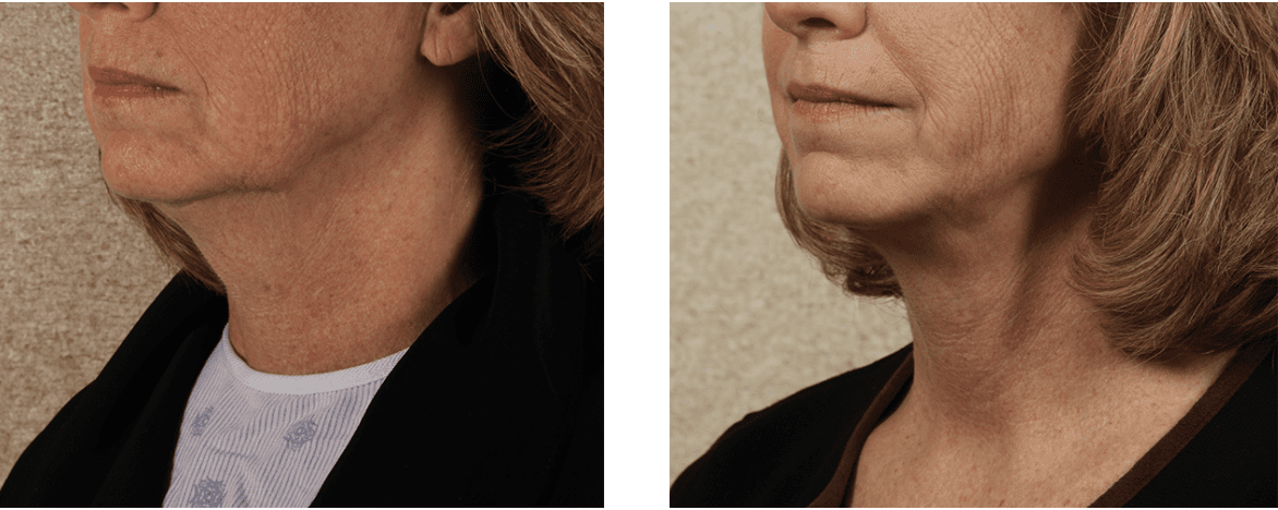Neck Lift Before and After Photos