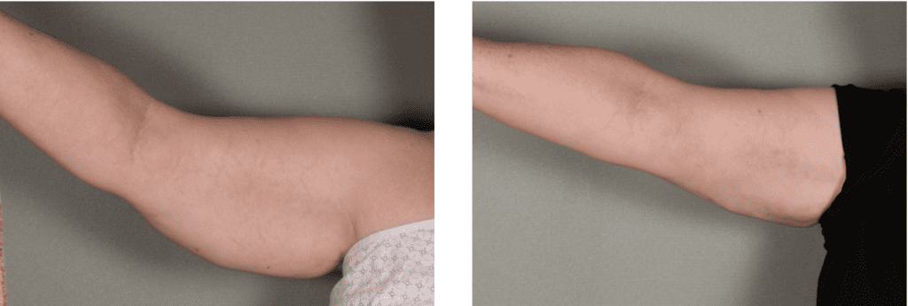 Arm Lift Before and After Photos