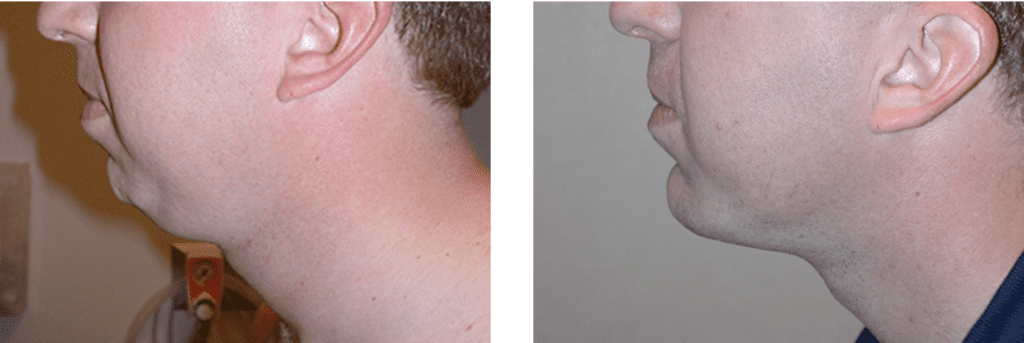 Chin Implant Before and After Photos