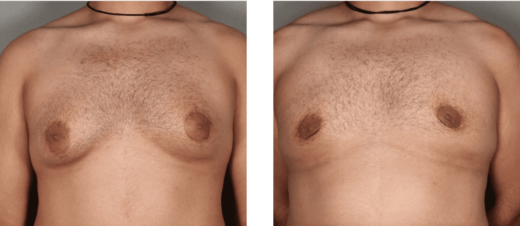 Dr. Benjamin Schlechter - Gynecomastia Surgery Before and After Photos