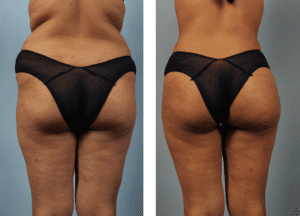 Brazilian Butt Lift Before and After Photos