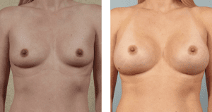 Breast Augmentation Before and After Photos