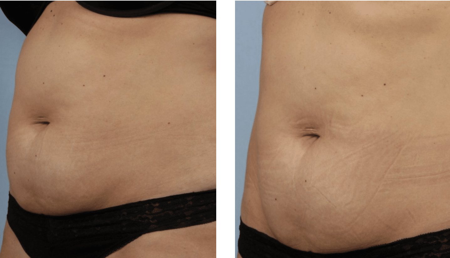 SculptSure® Before and After Photos