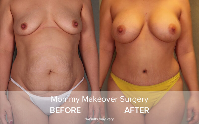 Before and after photos of a patient who underwent a Mommy Makeover (breast augmentation and tummy tuck) with Dr. Schlechter.