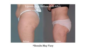 3-B3-Liposuction-abdomen-and-thighs-before--wpcf_500x600-ba-blog-img