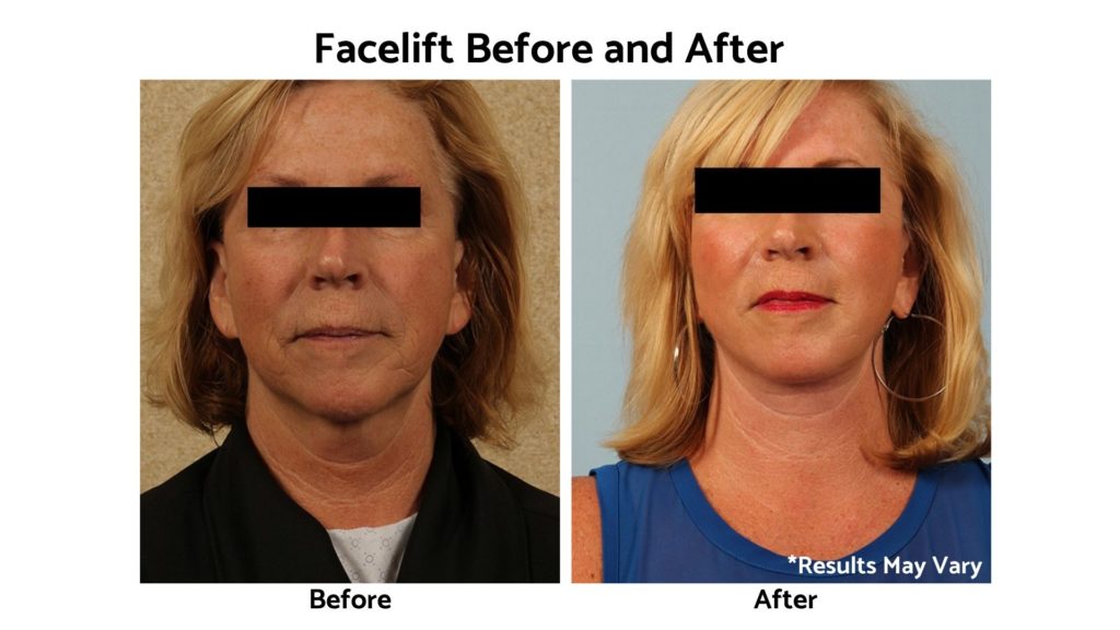65-Year-Old-Face-Lift-and-CO2-Perioral-9-Months-Post-Op-view-1-wpcf_500x600.jpg_timestamp=1566846907707-ba-blog-img