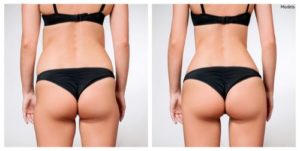 simulated before and after images that show potential results that can be achieved with liposuction-img-blog